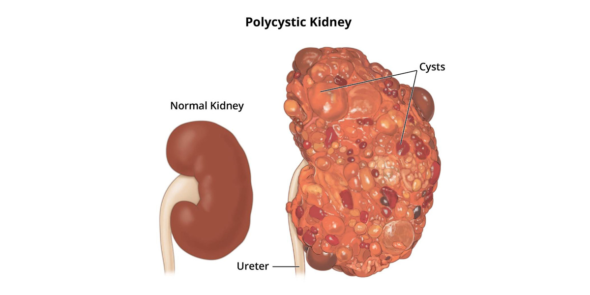 Polycystic Kidney Disease (PKD) 1 service polycystic kidney